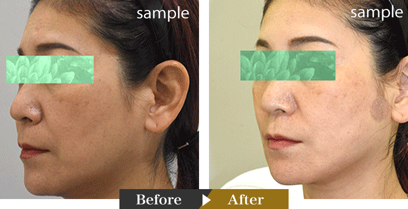 Improves the appearance of facial wrinkles and skin laxity Clinical Cases01