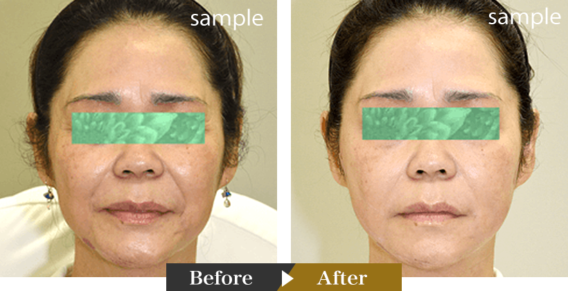Improves the appearance of facial wrinkles and skin laxity Clinical Cases02