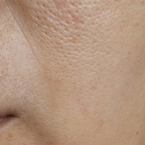 毛穴の引き締め、くすみ改善