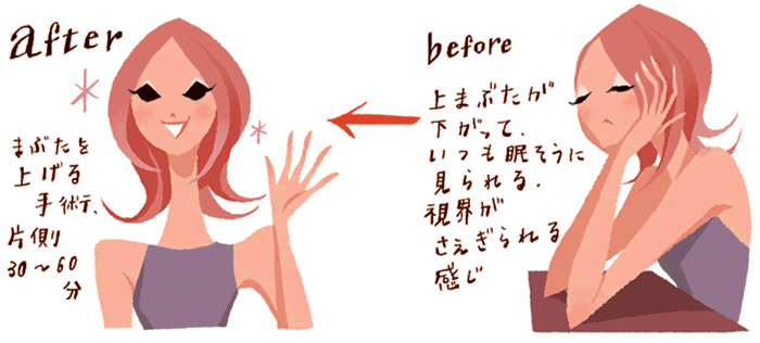 【before】上まぶたが下がっていつも眠そうに見られる。視界がさえぎられる感じ→【after】まぶたを挙げる手術 片側30～60分