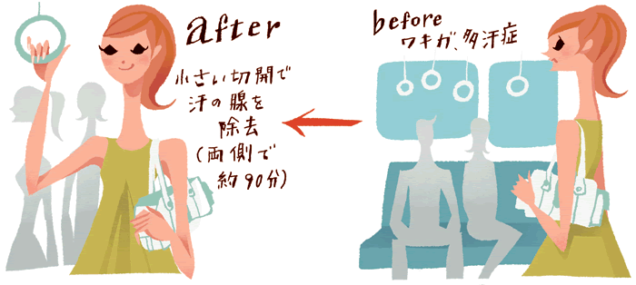 beforeワキガ、多汗症 after小さい切開で除去(両側で約90分)