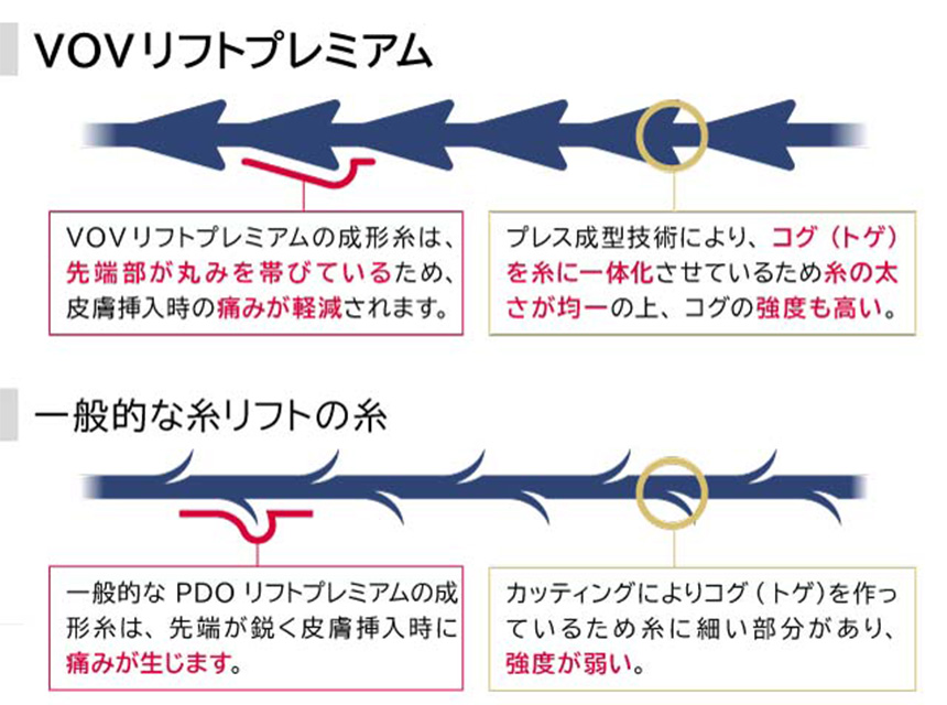 VOVリフトプレミアムと一般的な糸リフトの糸の違い